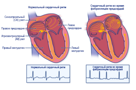 Фибрилляция Предсердий | Memorial Sloan Kettering Cancer Center