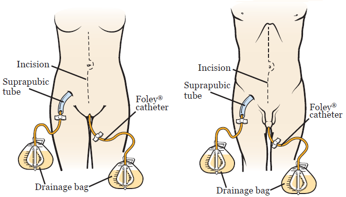 Belly Bag urine drainage systems (EMEA)