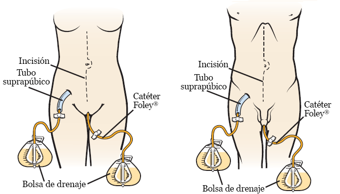 Figura 1. Anatomía femenina (izquierda) y anatomía masculina (derecha) con sonda suprapúbica y catéter Foley®