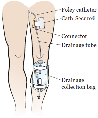 male foley catheter care