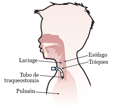 Figura 1. Colocación de tubo de traqueostomía