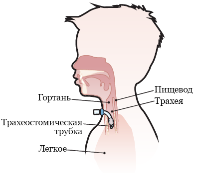 Рисунок 1.  Установка трахеостомической трубки