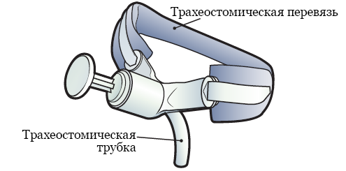 Рисунок 2.&nbsp; Трахеостомическая трубка и перевязь