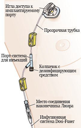 Рисунок 6. Зажимы на трубках имплантируемого порта