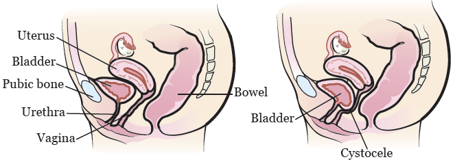 prolapsed bladder repair
