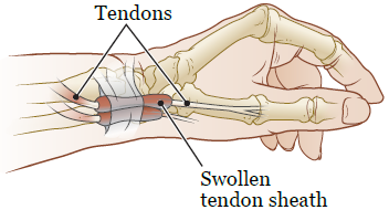Figure 1. Wrist with de Quervain's tenosynovitis