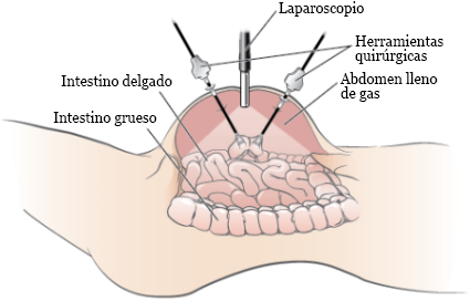 Figura 1. El abdomen durante una laparoscopia de diagnóstico