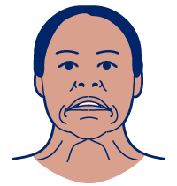 Ilustración de una persona tirando de las comisuras de los labios hacia abajo con los músculos del cuello sobresaliendo