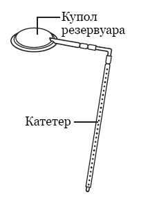 Рисунок 1.  Резервуар Ommaya