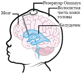 Рисунок 2.&nbsp; Установка резервуара Ommaya
