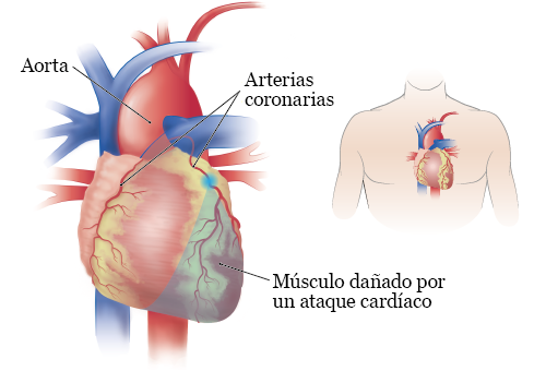 Figura 1.&nbsp; Músculo cardíaco dañado por la arteria coronaria obstruida