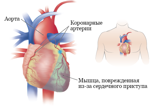 Рисунок 1. Сердечная мышца, поврежденная в результате блокирования коронарной артерии