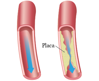 Figura 2. Arterias no obstruidas y obstruidas