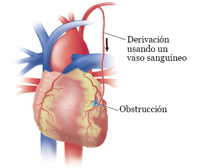 Figura 5. Derivación coronaria