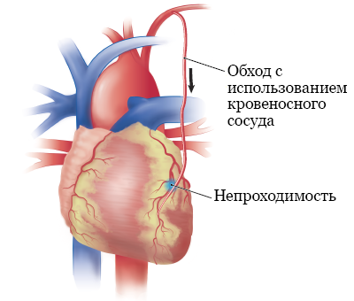 Рисунок 5. Аортокоронарный шунт