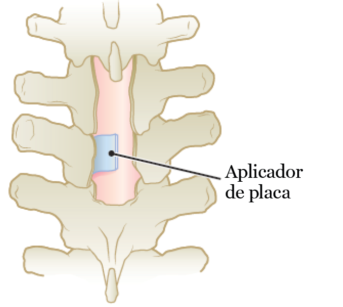 Figura 2. Aplicador de placa en la columna