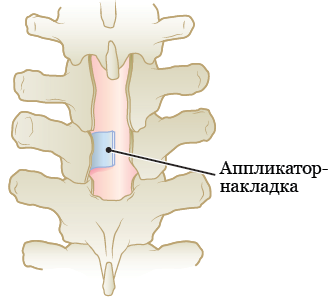 Рисунок 2.&nbsp; Аппликатор-накладка на позвоночнике