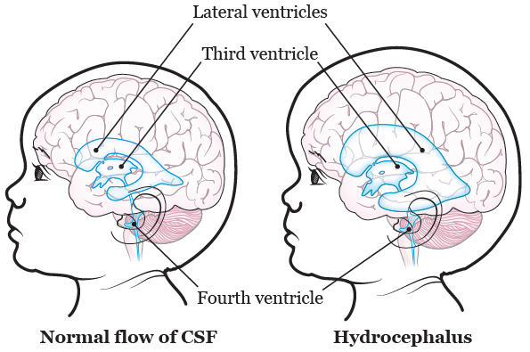 hydrocephalus ventriculostomy