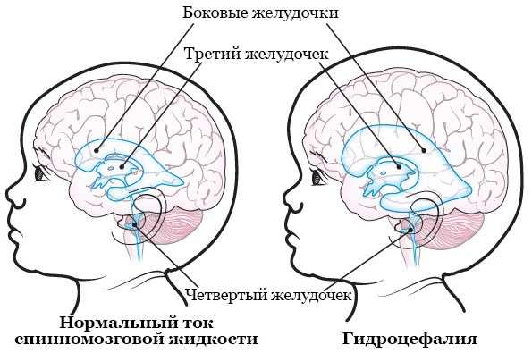 Рисунок 1.  Головной мозг с гидроцефалией и без нее