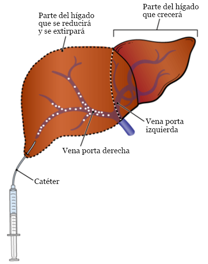 Figura 2. Embolización de vena porta en la vena porta derecha del hígado