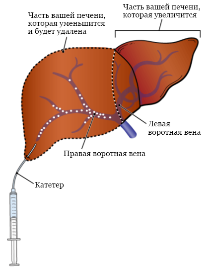 Рисунок 2.&nbsp; Эмболизация правой воротной вены печени