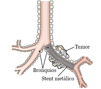 Figura 1. Un stent que abre el área estrecha de una vía aérea