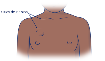 Figura 5. Sitios de incisión para la colocación del puerto