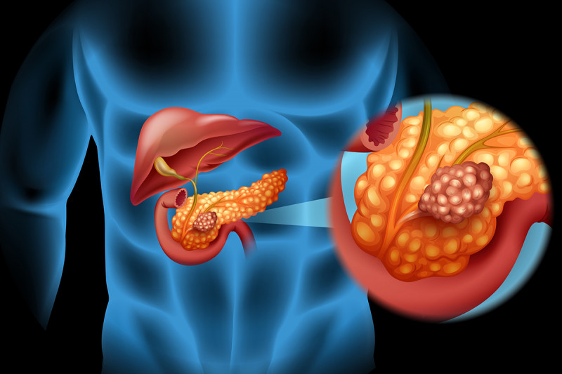 Why Is Pancreatic Cancer So Hard to Treat? | Memorial Sloan Kettering Cancer Center