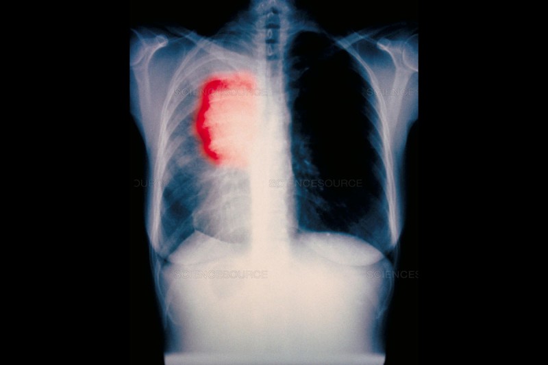 Image of a lung