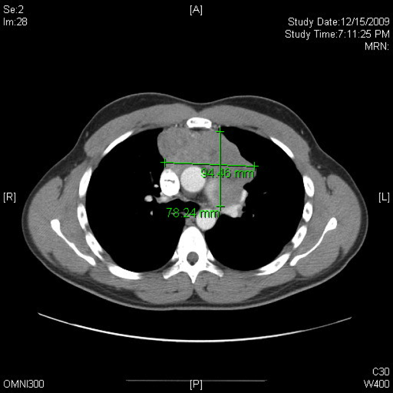 Experience and Expertise with Thymomas and Thymic Tumors