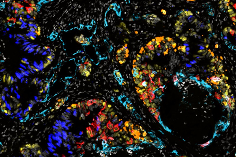 immunofluorescence image of colorectal cancer cells