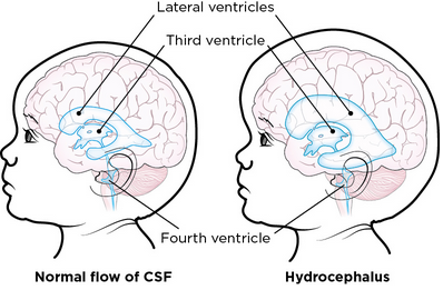 About Your Endoscopic Third Ventriculostomy (ETV) for Pediatric ...