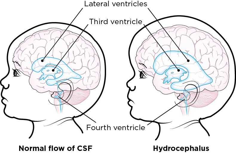 about-hydrocephalus-for-pediatric-patients-memorial-sloan-kettering