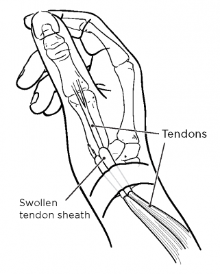 De Quervain's Tenosynovitis | Memorial Sloan Kettering Cancer Center