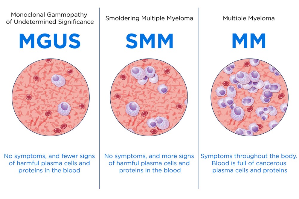 Multiple Myeloma | Memorial Sloan Kettering Cancer Center