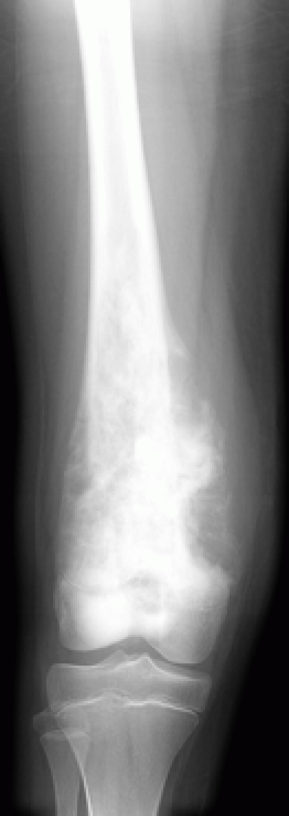 Bone Cancer: Image Bank: Scan of Leg with Osteosarcoma | Memorial Sloan ...