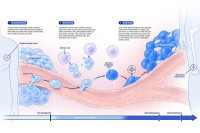 Information graphic explaining the stages of cancer metastasis