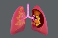 A Decision-Making Model for Selecting Surgery or Radiotherapy for Early-Stage Lung Cancer