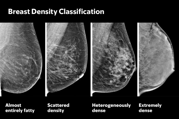 Dense Breast Tissue and Cancer Risk: What You Should Know | Memorial ...