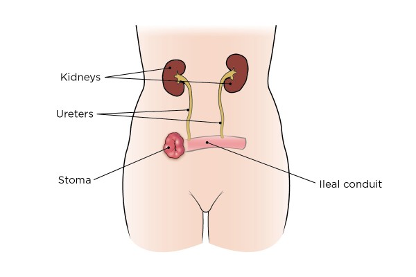 Bladder Cancer Surgery Memorial Sloan Kettering Cancer Center 5136