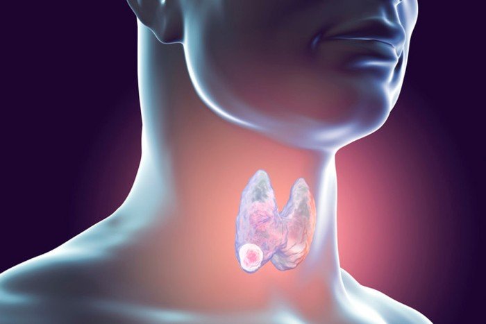 Breaking Bad: Researchers Find Mutations that Turn Thyroid Cancers ...