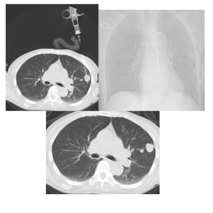 Biopsy And Personalized Medicine In Non Small Cell Lung Cancer Nsclc Memorial Sloan 5855