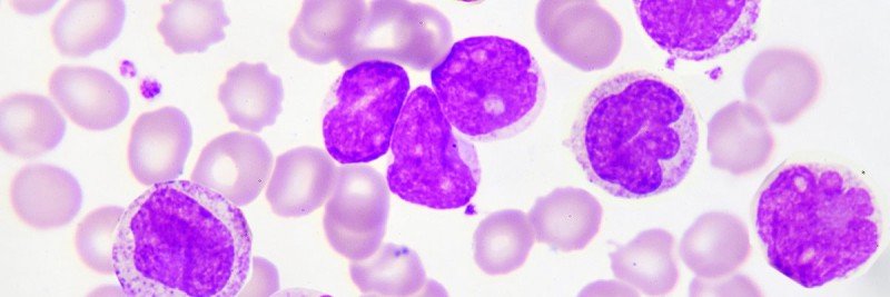  Acute Myeloid Leukemia AML Memorial Sloan Kettering 