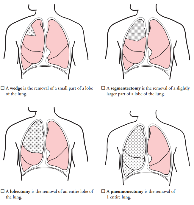 About Your Thoracic Surgery | Memorial Sloan Kettering Cancer Center